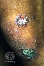 Epidermolysis bullosa acquisita