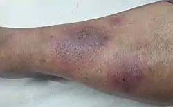 Erythema nodosum in rather dark skin