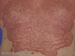 Erythema gyratum repens