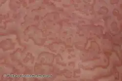 Erythema gyratum repens