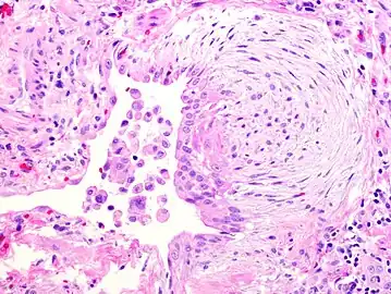 A fibroblast focus in a surgical lung biopsy of UIP. Hematoxylin-eosin stain, high magnification. The white space to the left is an airspace. The pale area to the right is a fibroblast focus. It is an area of active fibroblast proliferation within the interstitium of the lung.