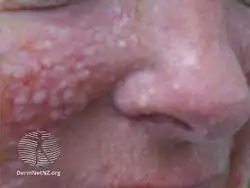 Fibrofolliculomas in Birt Hogg Dube syndrome