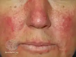 Fibrofolliculomas in Birt Hogg Dube syndrome