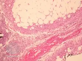 Alpha-1 antitrypsin deficiency panniculitis