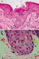 Graft-versus-host disease pathology