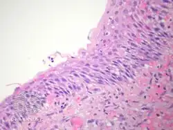 Branchial cleft cyst/pathology