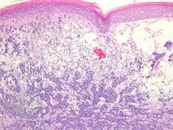 Merkel-cell carcinoma/pathology