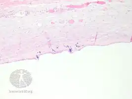 pathology-Urachal cyst