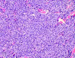 Plasmacytoma/pathology