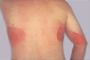 Ionizing radiation burn: large red patches of skin on the back and arm from multiple prolonged fluoroscopy procedures