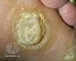 Focal palmoplantar keratoderma