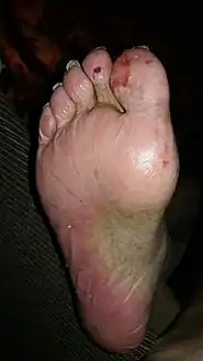 Foot on capecitabine