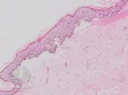 Fracture blister histology