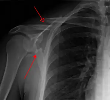 X-ray showing a fracture of the clavicula and scapula