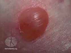 Friction blister