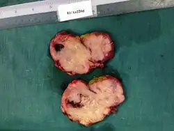 Gallbladder carcinoma