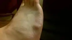 Cyst on dorsum of right foot