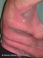 Generalised pustular psoriasis