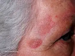 Granuloma faciale