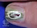 Green nail due to pseudomonas infection