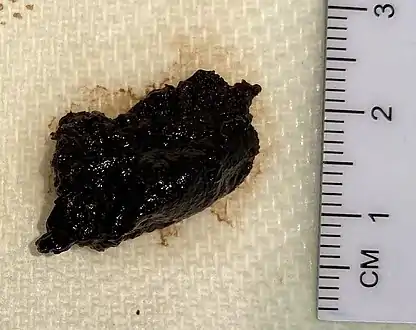 Resected fragments of a brain tumor, and in this case the very dark appearance supports a diagnosis of metastatic pigment-forming melanoma