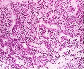 True null cell adenomas are typically composed of uniform, mildly atypical cells with chromophobic cytoplasm. This case has papillary architecture similar to gonadotroph adenomas.