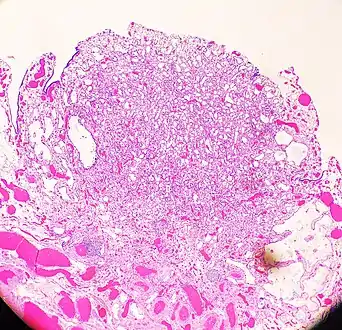 An adenomatoid tumor of the fallopian tube, low magnification, displaying infiltrative-like borders.