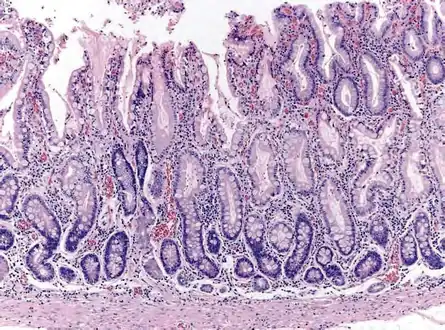 Histopathology of antral mucosa with atrophy. H&E 10x. Antral gastric mucosa with accentuated atrophy because replacement by extensive intestinal metaplasia.