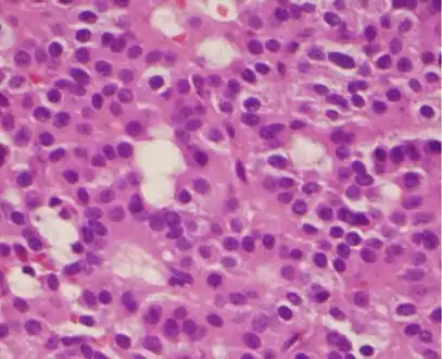 A silent gonadotroph pituitary adenoma which is, in this case, is eosinophilic (contrary to normal, basophilic, gonadotroph cells)