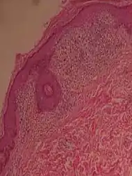 Histopathology of lichen nitidus: Downward extension of the rete ridges at the lateral margins of a lymphohistiocytic infiltrate, resulting in a typical "claw clutching a ball" appearance.