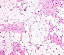 Histopathology of a lipoma: The mass is composed of lobules of mature white adipose tissue divided by fibrous septa containing thin-walled capillary-sized vessels.