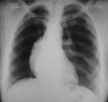 Hodgkin lymphoma- hilum overlay sign