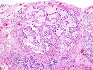 Appearance of honeycomb change in a surgical lung biopsy at low magnification. The dilated spaces seen here are filled with mucin. Hematoxylin-eosin stain, low magnification.