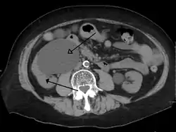 Massive hydronephrosis as marked by the arrow.