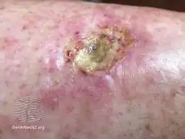 Hydroxyurea-induced leg ulcer