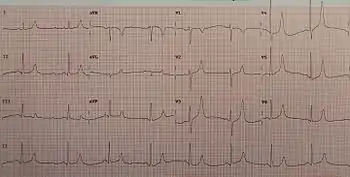 An ECG of a person with a potassium of 5.7 mg/dL showing large T waves and small P waves