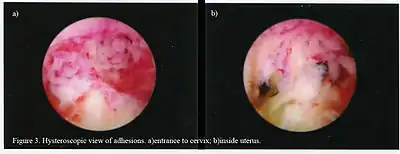 Hysteroscopic view.