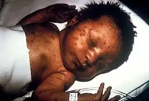 Infant with skin lesions from congenital rubella