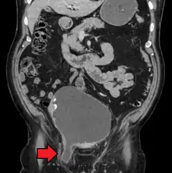 An inguinal hernia which contains part of the bladder. Bladder cancer also present.