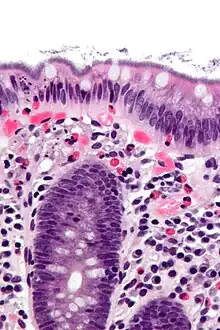 Micrograph showing intestinal spirochetosis