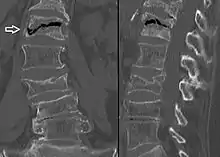 The intravertebral vacuum cleft sign (white arrow) is a sign of avascular necrosis. (Avascular necrosis of a vertebral body after a vertebral compression fracture is called Kümmel's disease.)