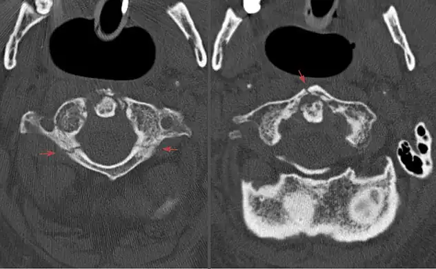 Axial CT scan showing a Jefferson fracture.