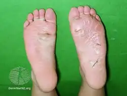 Juvenile plantar dermatosis