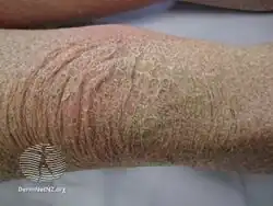 Kava ichthyosis