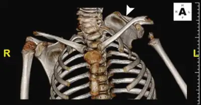 CT scan showing Sprengel's deformity of the left side (arrow) and fused cervical vertebrae, as seen in Klippel–Feil syndrome