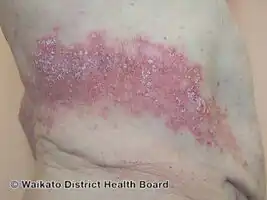 Koebnerised psoriasis