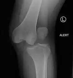 A lateral dislocation of the knee