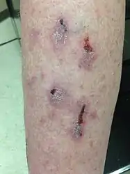 Lichen planus on the shin