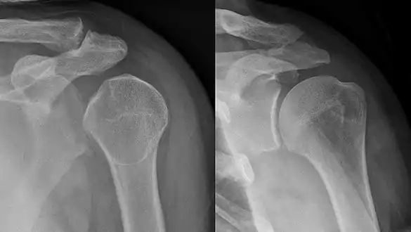 Lightbulb sign indicative of posterior shoulder dislocation shown on the left. On the right, the same shoulder after reduction.