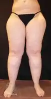 Lipoedema stage II